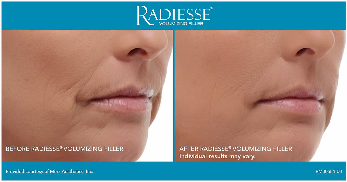 Radiesse®